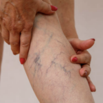 Spider Veins Demystified: Causes, Risk Factors, and Treatment