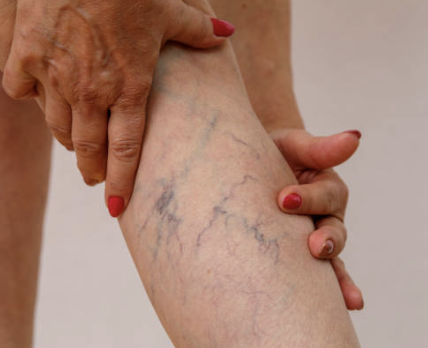 Spider Veins Demystified: Causes, Risk Factors, and Treatment