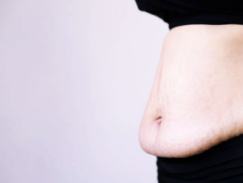 Emsculpt NEO to Address Diastasis Recti after Pregnancy