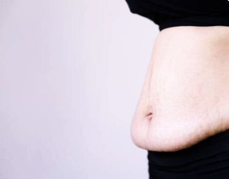 Emsculpt NEO to Address Diastasis Recti after Pregnancy